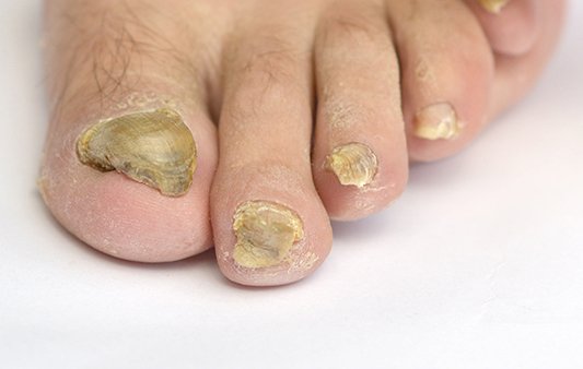 Thick Toenails | Clinical Blog | ACE Feet in Motion